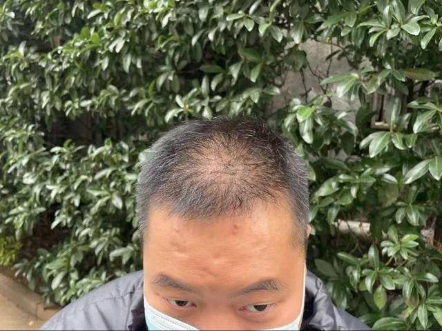 “还能反光<strong></p>
<p>sc 虚拟币</strong>！”长沙男子植发近9月称后脑勺“像狗啃过”