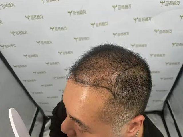 “还能反光<strong></p>
<p>sc 虚拟币</strong>！”长沙男子植发近9月称后脑勺“像狗啃过”