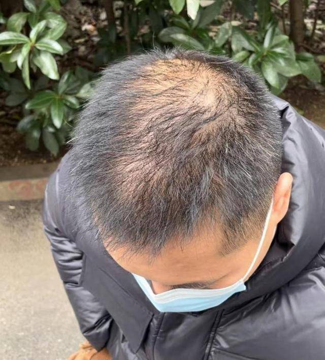 “还能反光<strong></p>
<p>sc 虚拟币</strong>！”长沙男子植发近9月称后脑勺“像狗啃过”