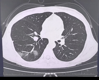 查出流感没在意<strong></p>
<p>合约</strong>，女子硬扛三天后肺都“白”了……