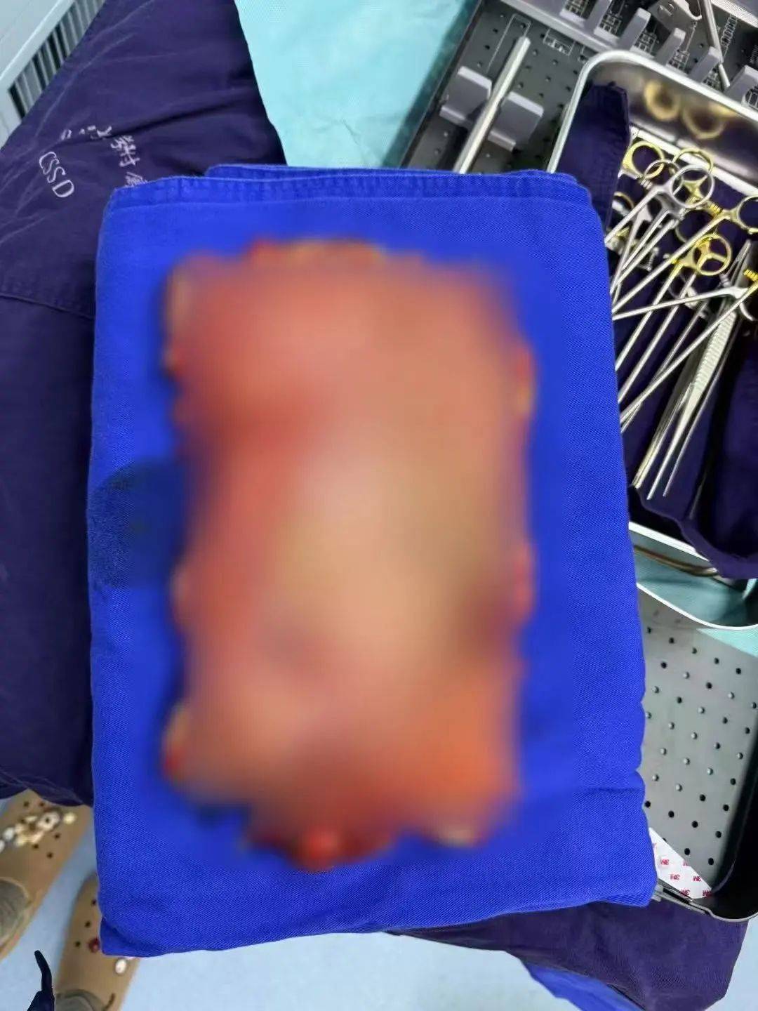 女子多器官衰竭、整个胃被摘除<strong></p>
<p>合约</strong>，医生清理出10斤……紧急提醒