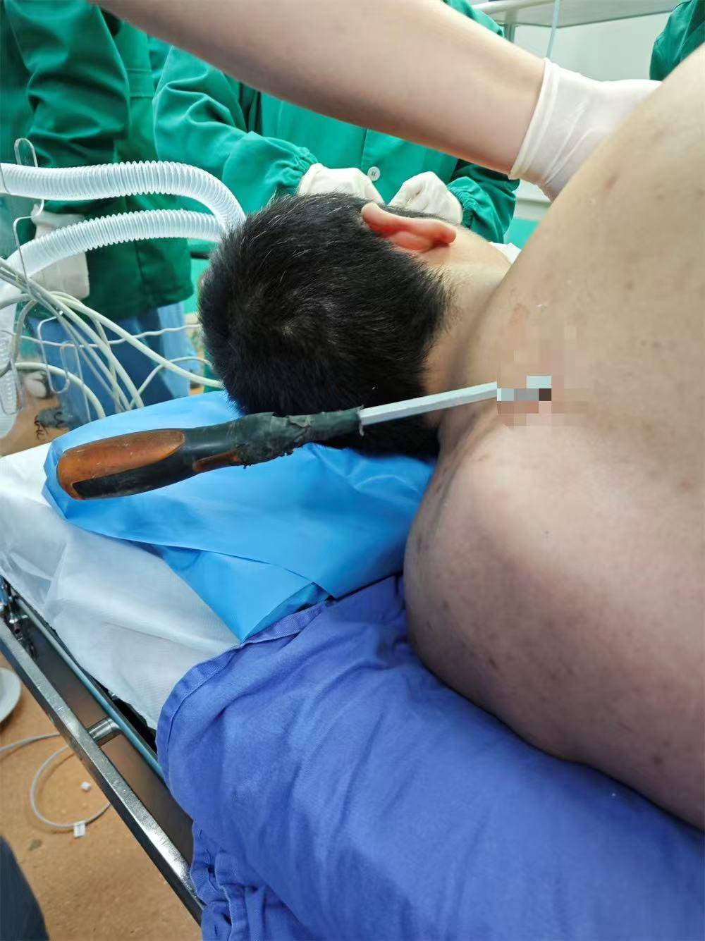 20米高空掉落螺丝刀直插男子胸腔<strong></p>
<p>原油预处理</strong>！医生：不要自行拔除