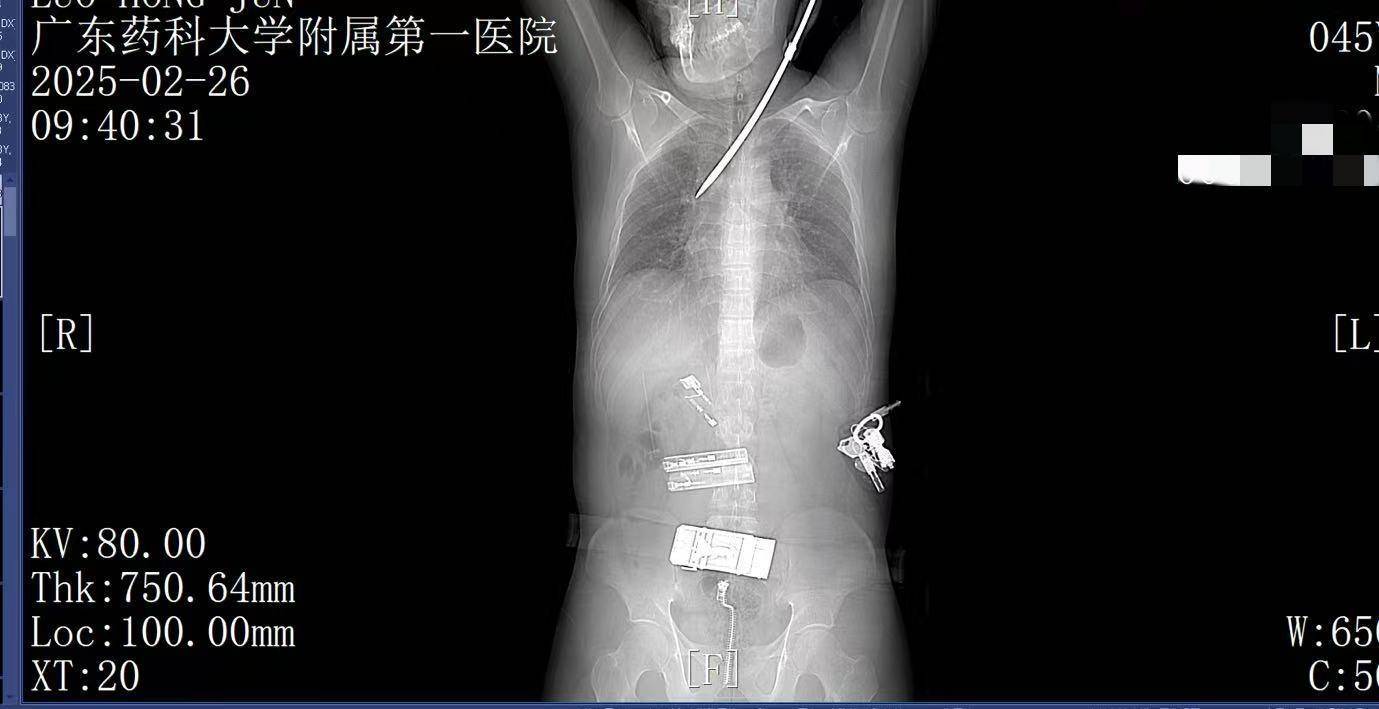 20米高空掉落螺丝刀直插男子胸腔<strong></p>
<p>原油预处理</strong>！医生：不要自行拔除
