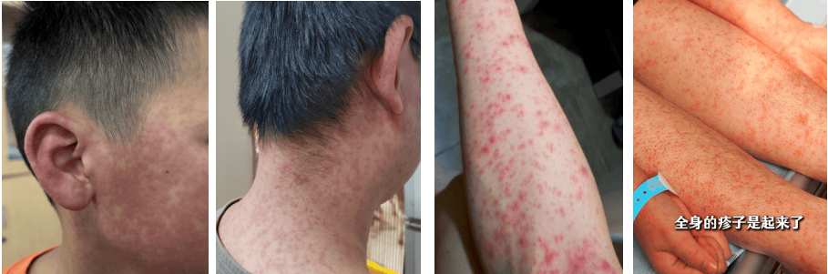 超6000例<strong></p>
<p>中原油田招聘信息</strong>！仍在新增！或发展成慢性病及有后遗症！上海华山医院：这些驱蚊产品没用！