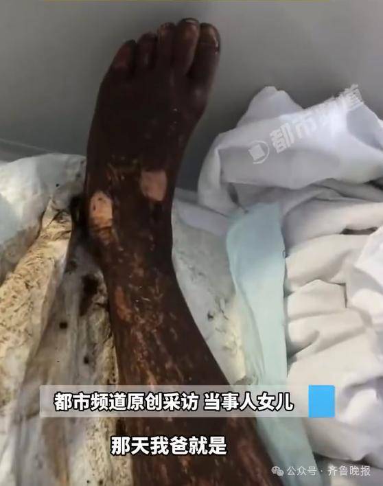 安徽宣城一男子走路玩手机<strong></p>
<p>原油模拟</strong>，一脚踩中打架的竹叶青和五步蛇，被俩毒蛇咬3口！医院：暂无生命危险，正在治疗