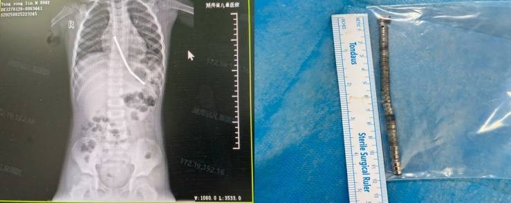 整整40颗<strong></p>
<p>原油后期走势</strong>！湖南3岁男童身体里取出……医生紧急提醒