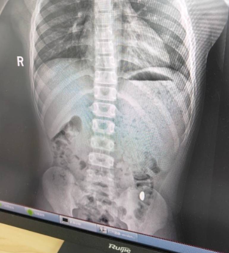 “熊孩子”误吞10克重金豆<strong></p>
<p>电商资讯平台</strong>，妈妈：天天叮嘱他不要在外面拉屎