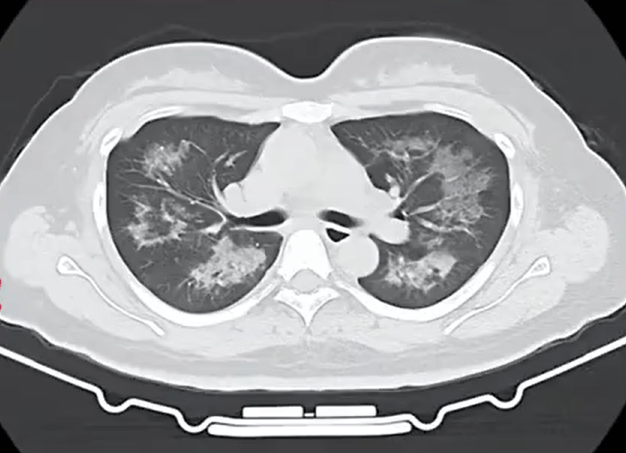 每天用2次<strong></p>
<p>相关资讯</strong>，22岁女主播肺里长满阴影！很多人不注意