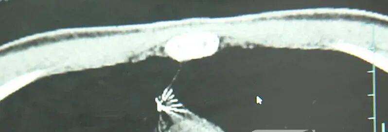 17岁小伙参军体检发现胸腔内有根5cm缝衣针<strong></p>
<p>上海资讯</strong>,父母回忆或是1岁时扎入,取出时已锈迹斑斑