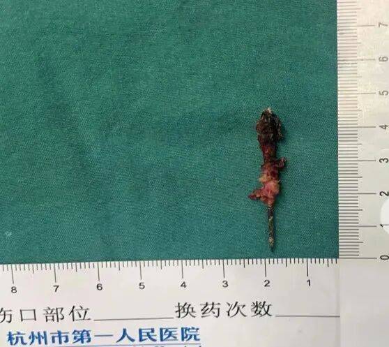 17岁小伙参军体检发现胸腔内有根5cm缝衣针<strong></p>
<p>上海资讯</strong>,父母回忆或是1岁时扎入,取出时已锈迹斑斑